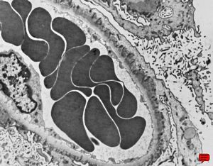  M,60y. | membranous glomerulopathy - st.I